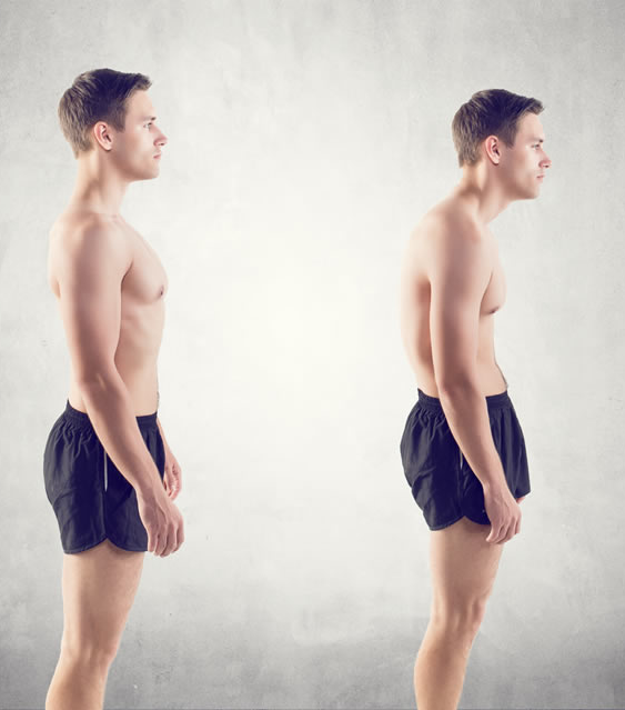 Poor posture: Upper Crossed Syndrome | Osteopathy Connections