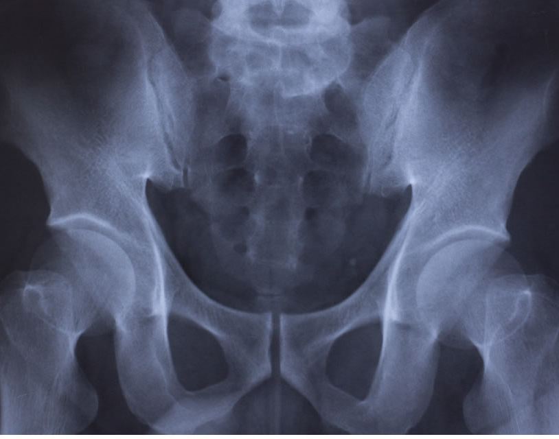 Back Pain, Sacro Iliac Irritation | Osteopathy Connections