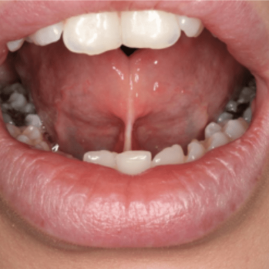 Adult tongue tie assessment
