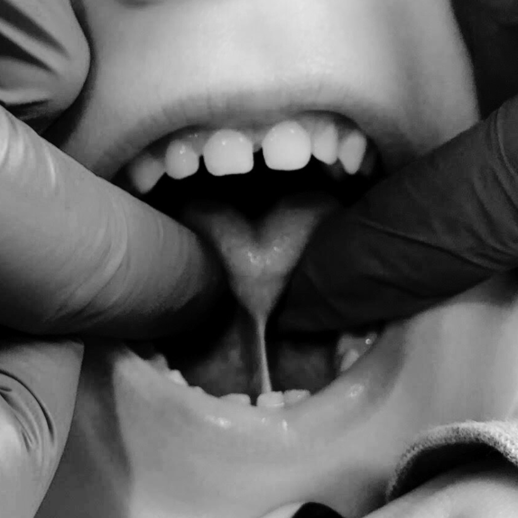 tongue tie assessment