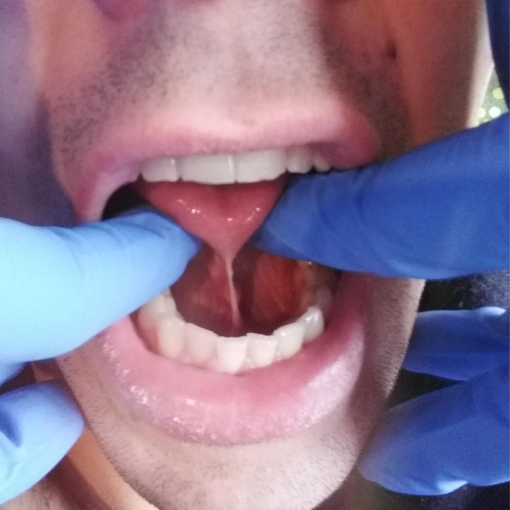 Adult tongue tie assessment | Osteopathy Connections